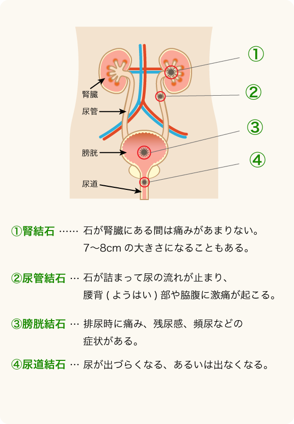 尿路結石外来｜豊中市の泌尿器科｜まつざき腎泌尿器科クリニック